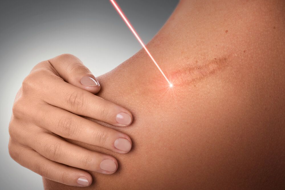 Laser Treatment For Scars, Warren, OH