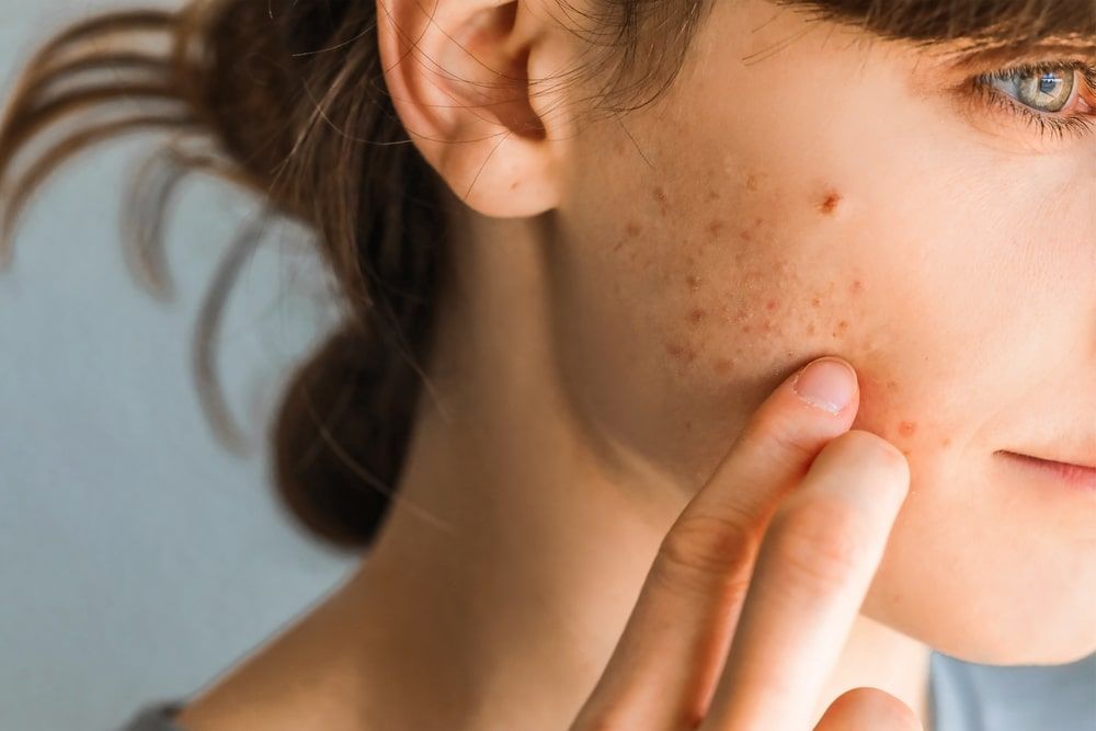 Redness and peeling of the skin on the face